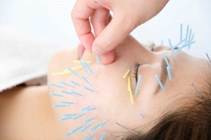 顔へ鍼治療